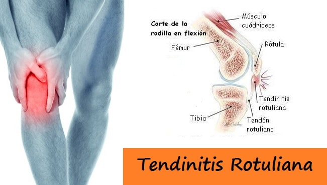 tendinitis rotuliana