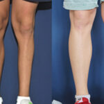 ¿Qué causa la pérdida de masa muscular en las piernas?